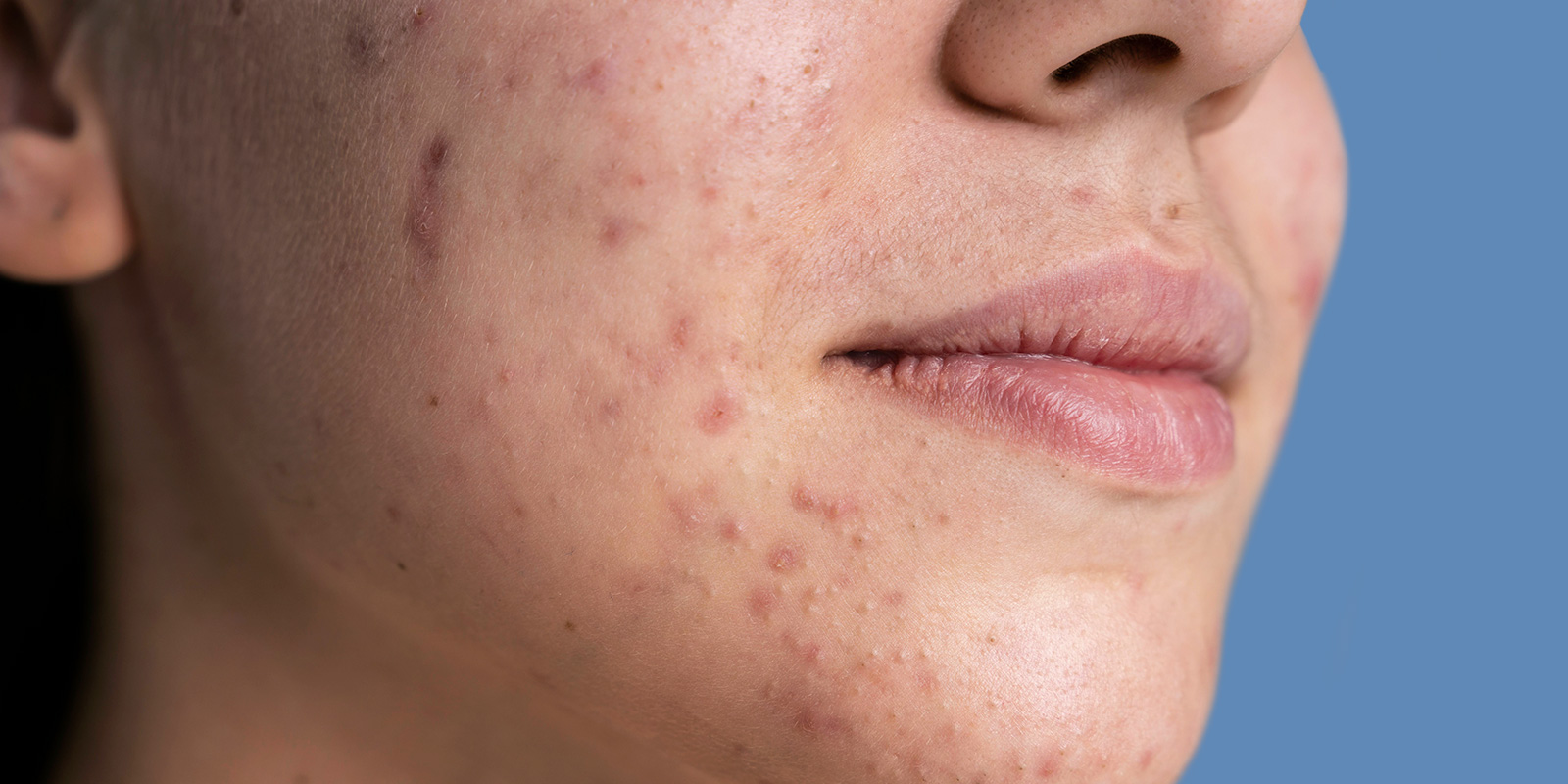 ?How do I get rid of acne