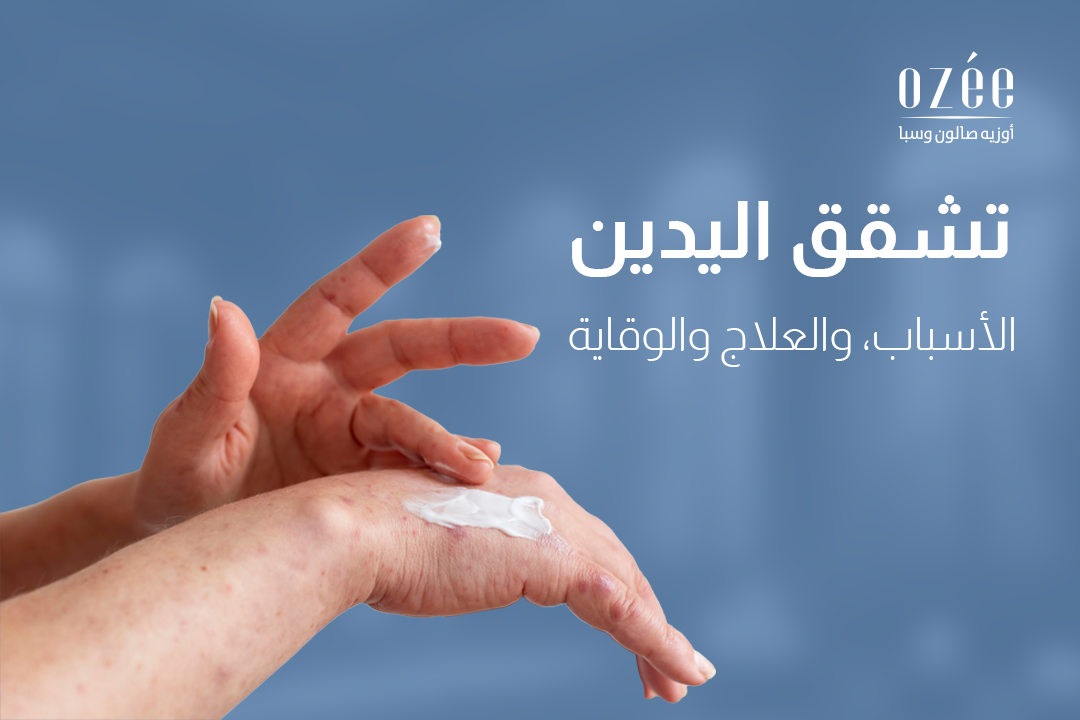 Cracked Hands: Causes, Treatment, and Prevention