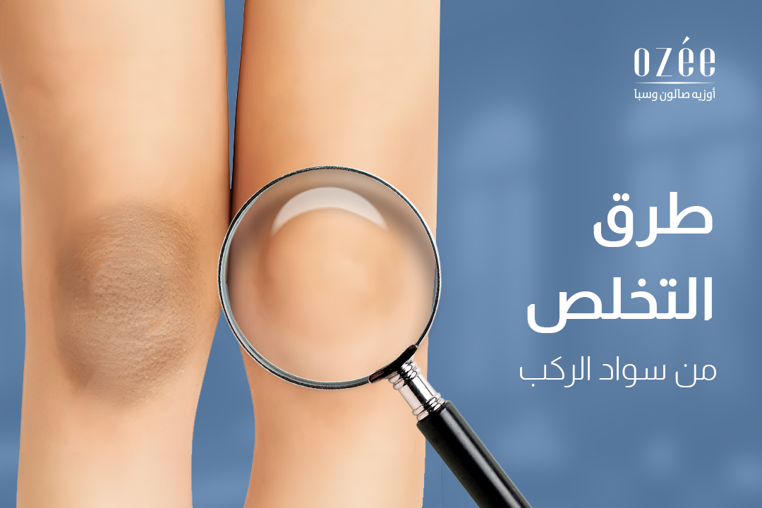 Ways to Get Rid of Dark Knees