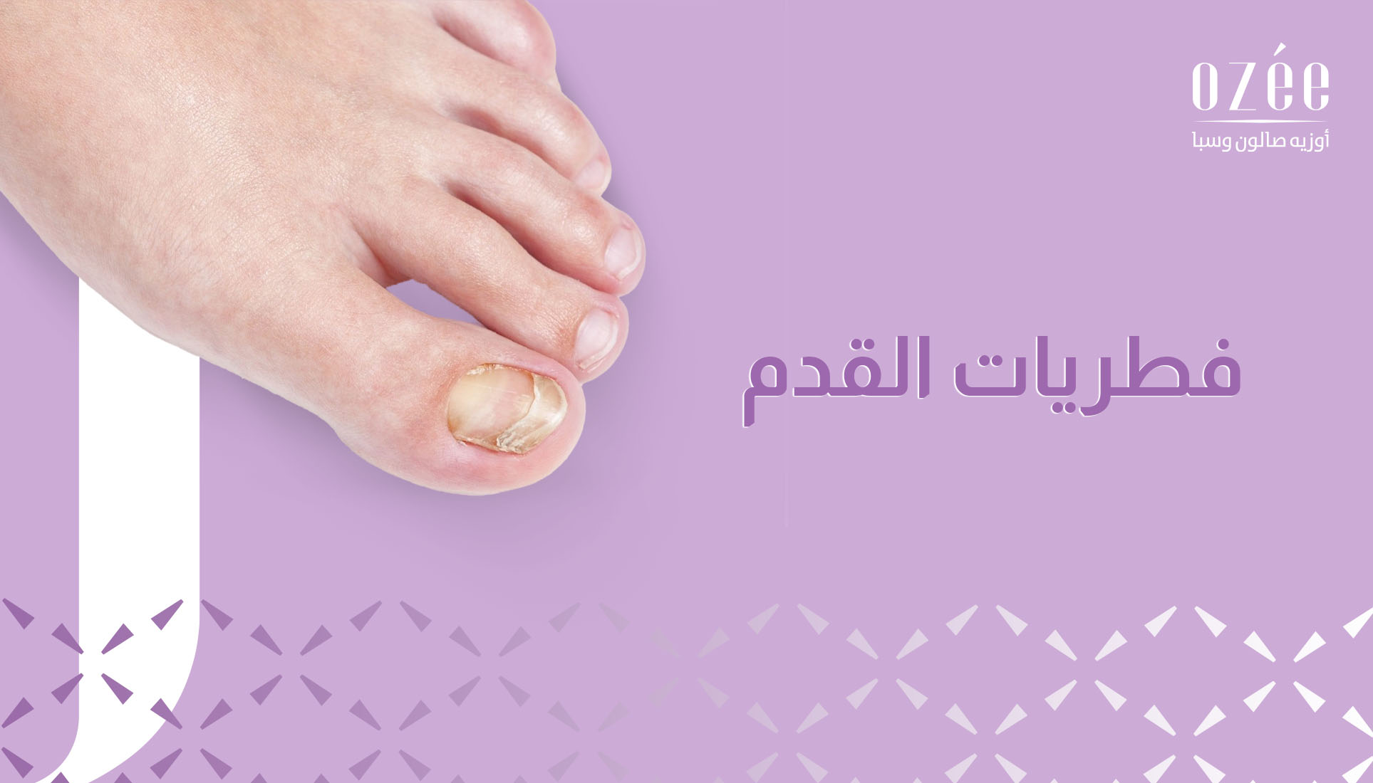 A Complete Guide to Getting Rid of Toenail Fungus: Causes, Symptoms, and Treatment Methods